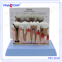 PNT-0528 Modelo de dentes dentais de doença periodontal de alto grau